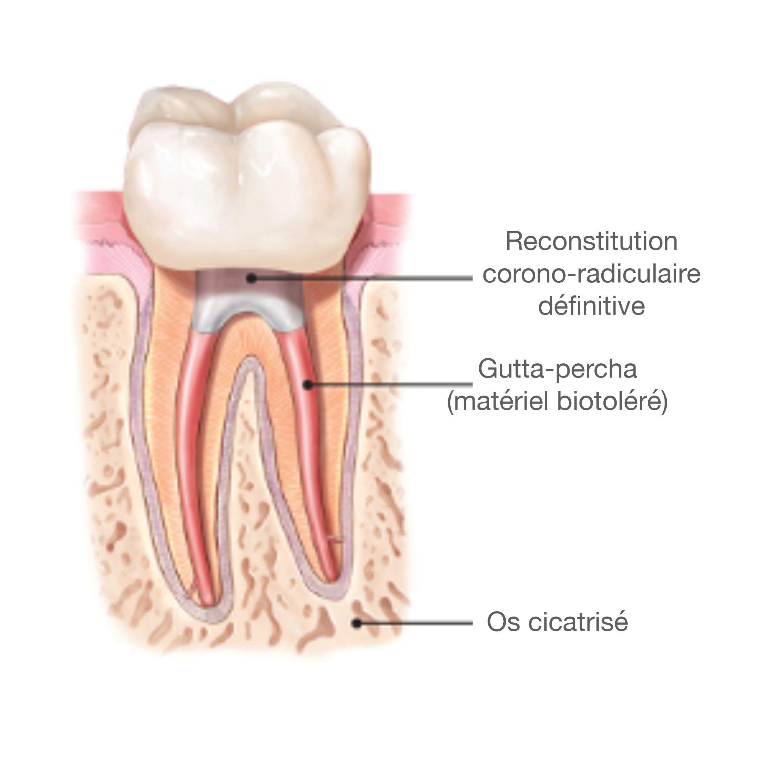 Endodontie: des soins pour restaurer la dent de l'intérieur